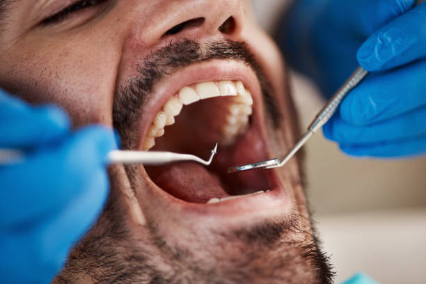Best Emergency Dentist for Knocked-Out Tooth in Brent, FL